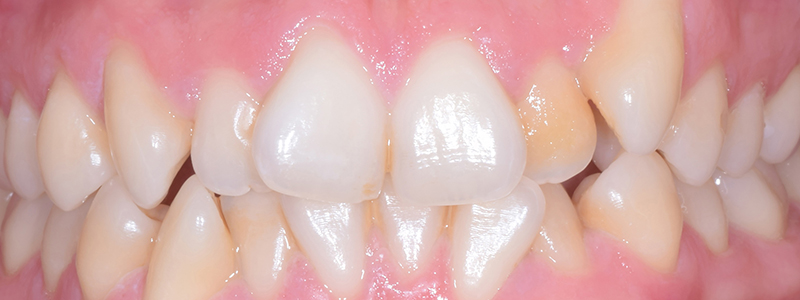 Invisalign patient before treatment at The Oxford Smile Clinics