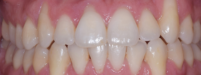 The same Invisalign patient after 12 months of treatment at The Oxford Smile Clinics
